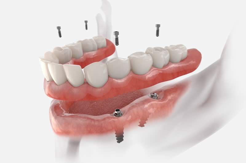 Full Arch Implants