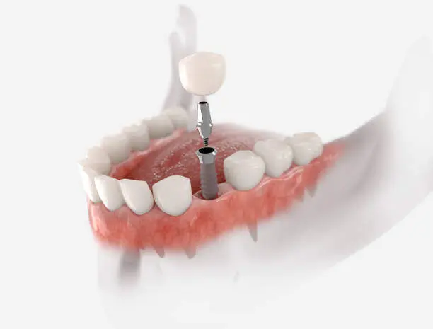 Single Implants & Bridges